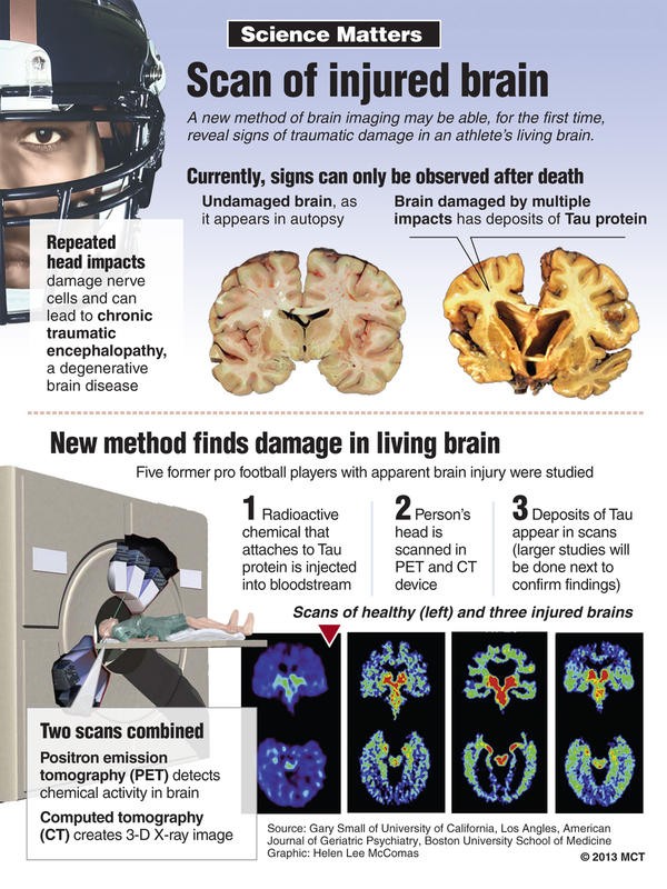 Will a New Way to Diagnose CTE Change Football? - The Atlantic